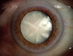 cataracta_1