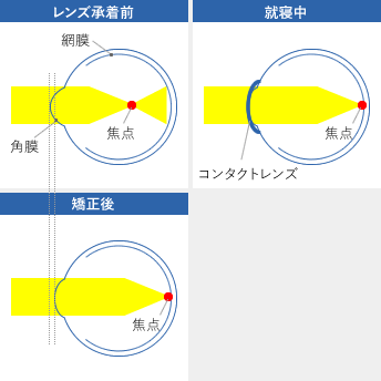 オルソケラトロジー治療イメージ