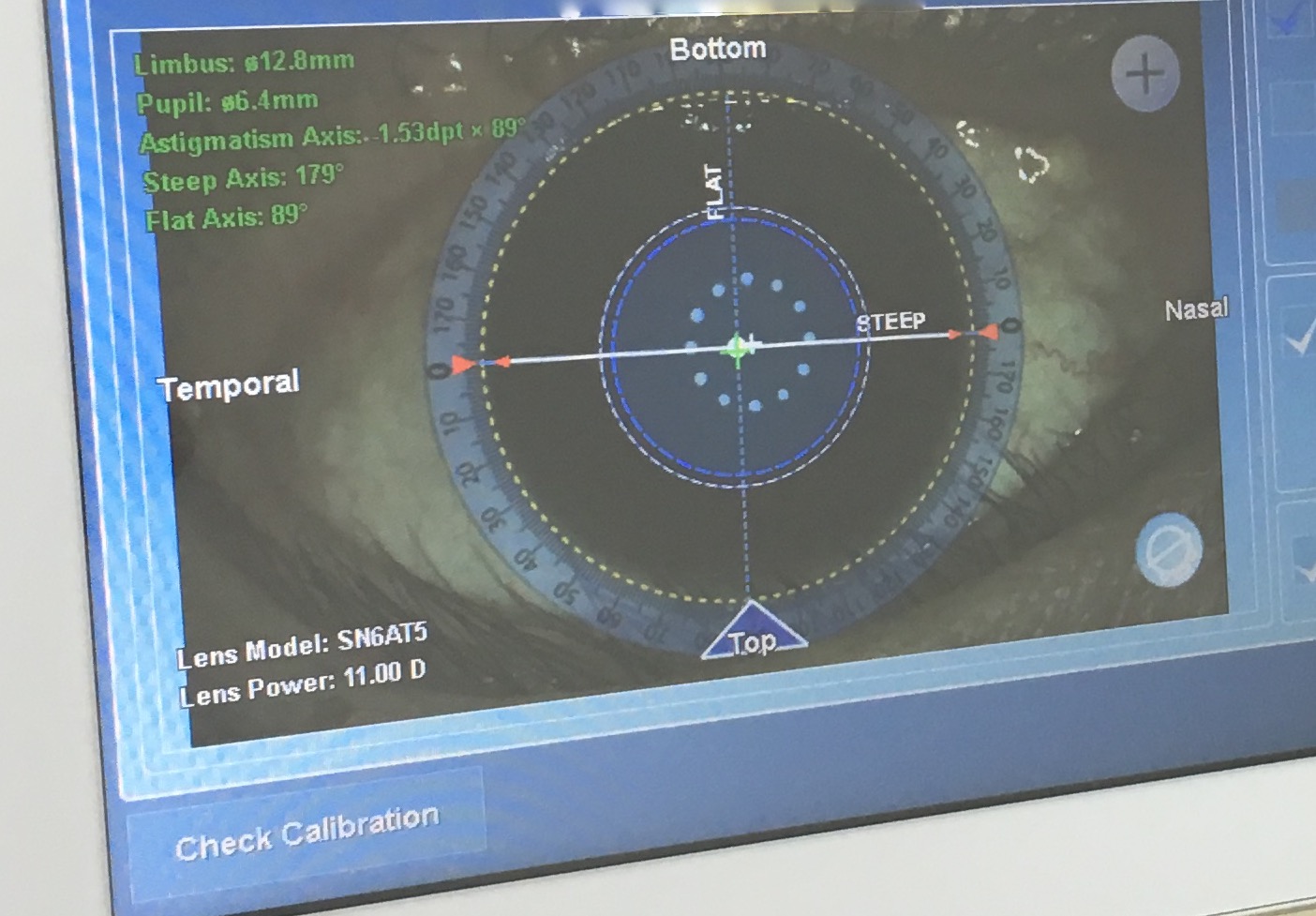 乱視：手術を受ける時期はいつですか？