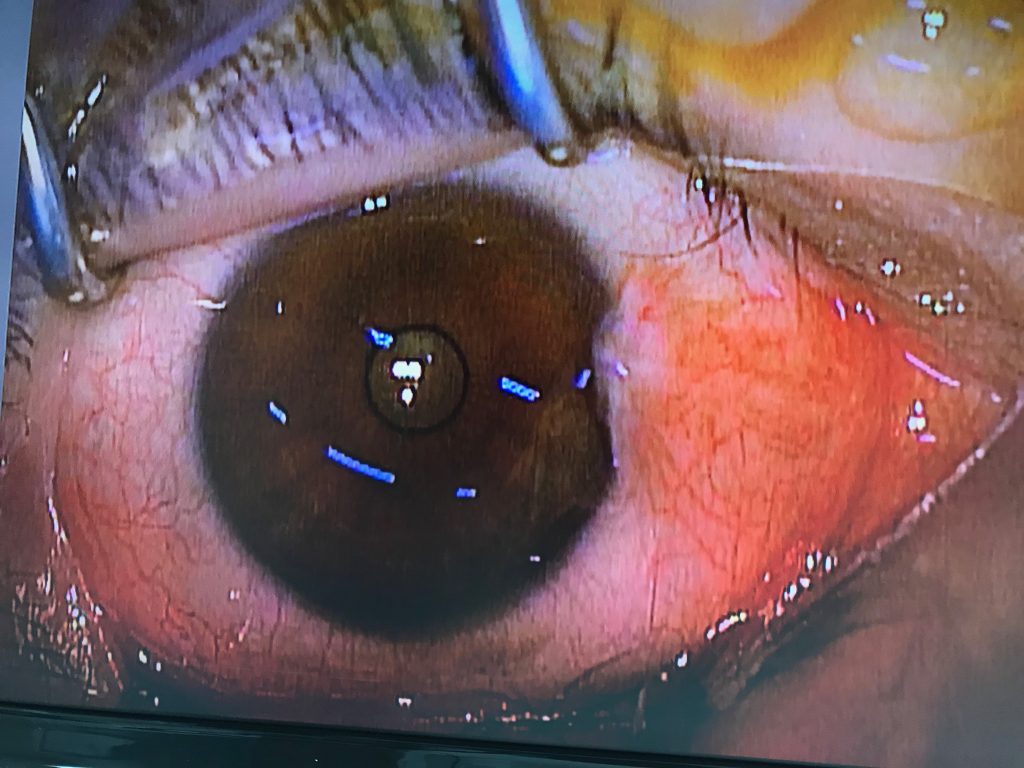 翼状片手術 柳津あおやま眼科クリニック