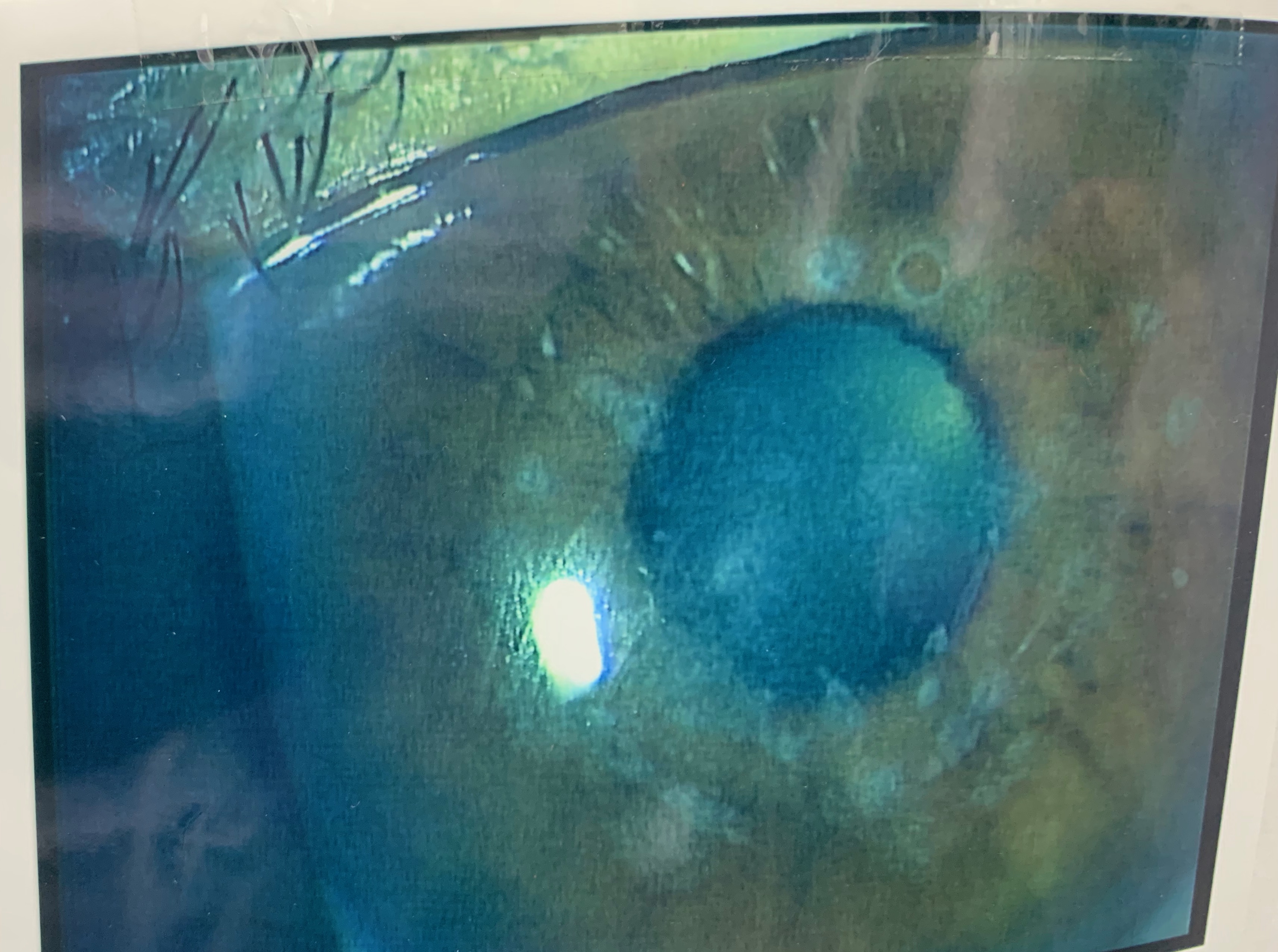 治療的角膜切除術（PTK) | 柳津あおやま眼科クリニック