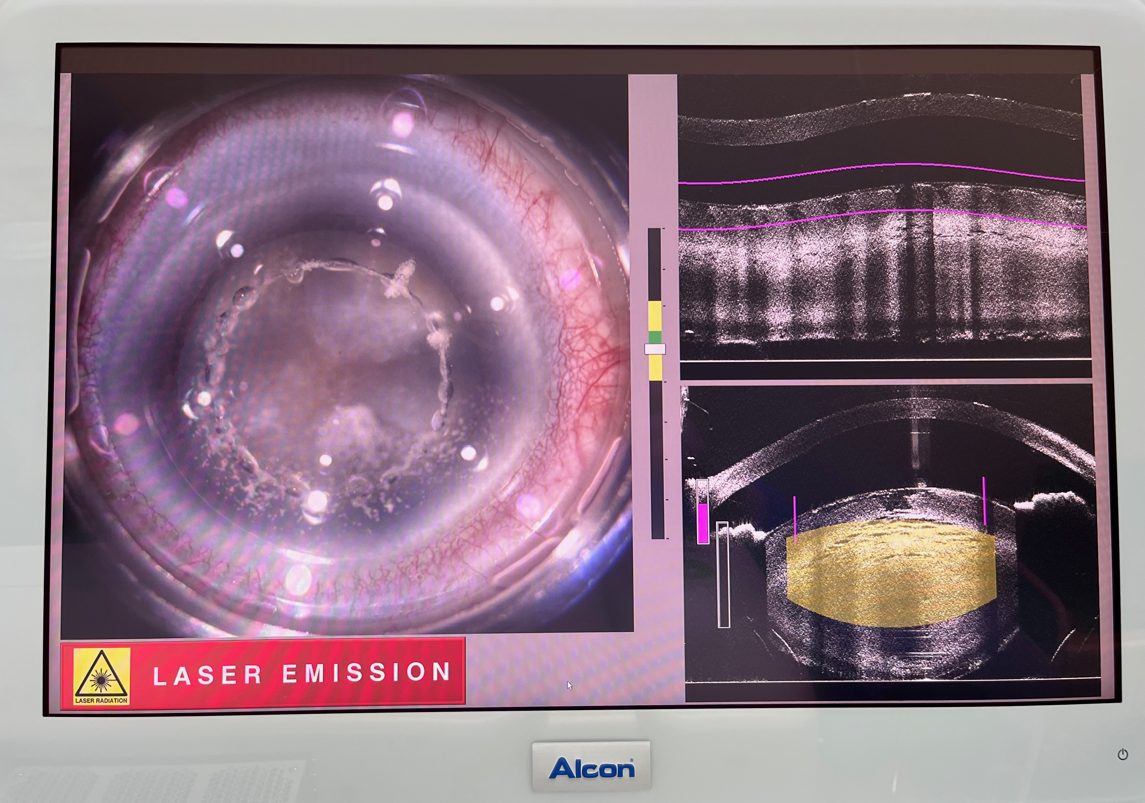 過熟白内障のレーザー手術 | 柳津あおやま眼科クリニック
