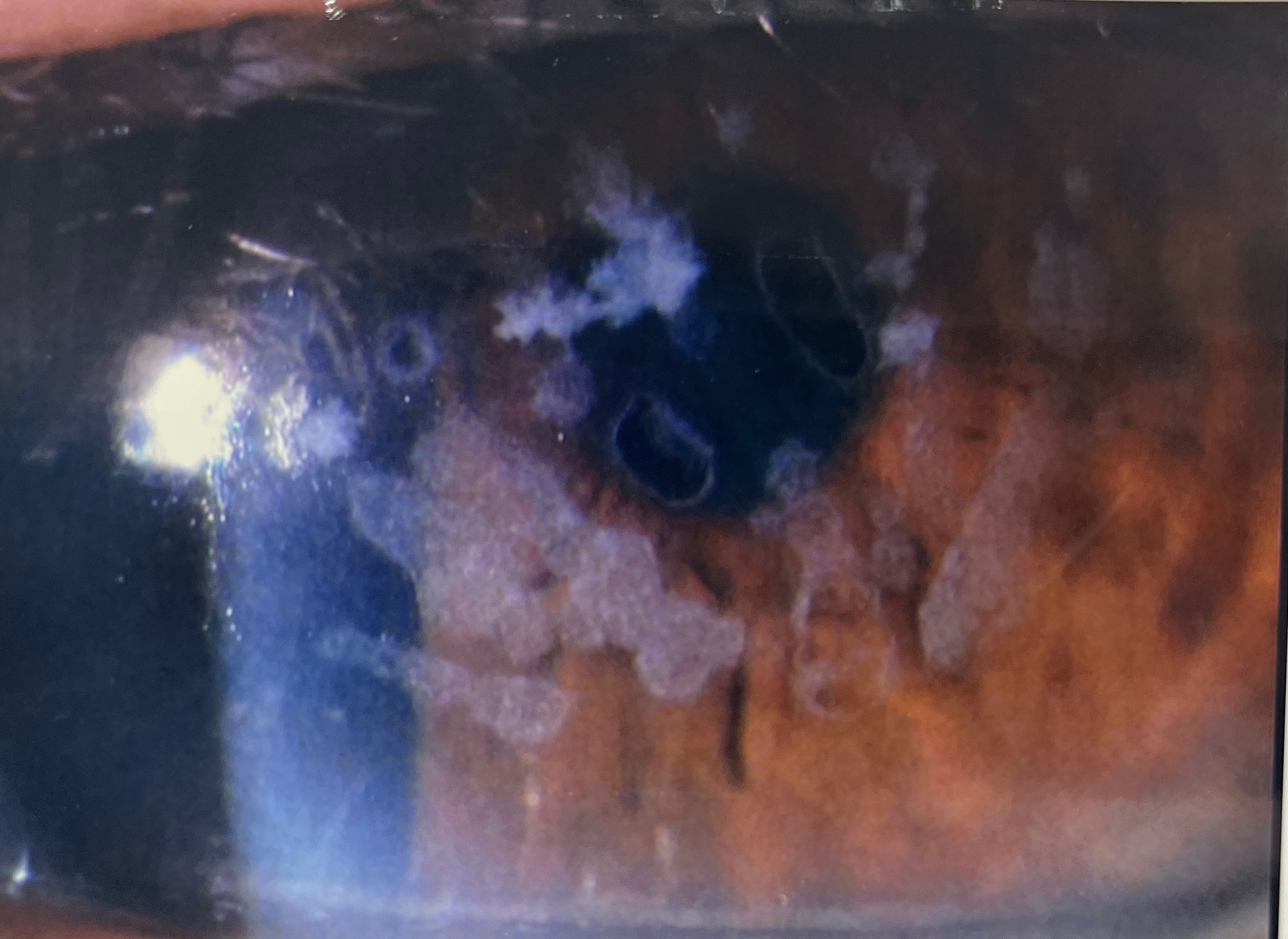 角膜の混濁治療 〜治療的角膜切除術（PTK）〜 | 柳津あおやま眼科