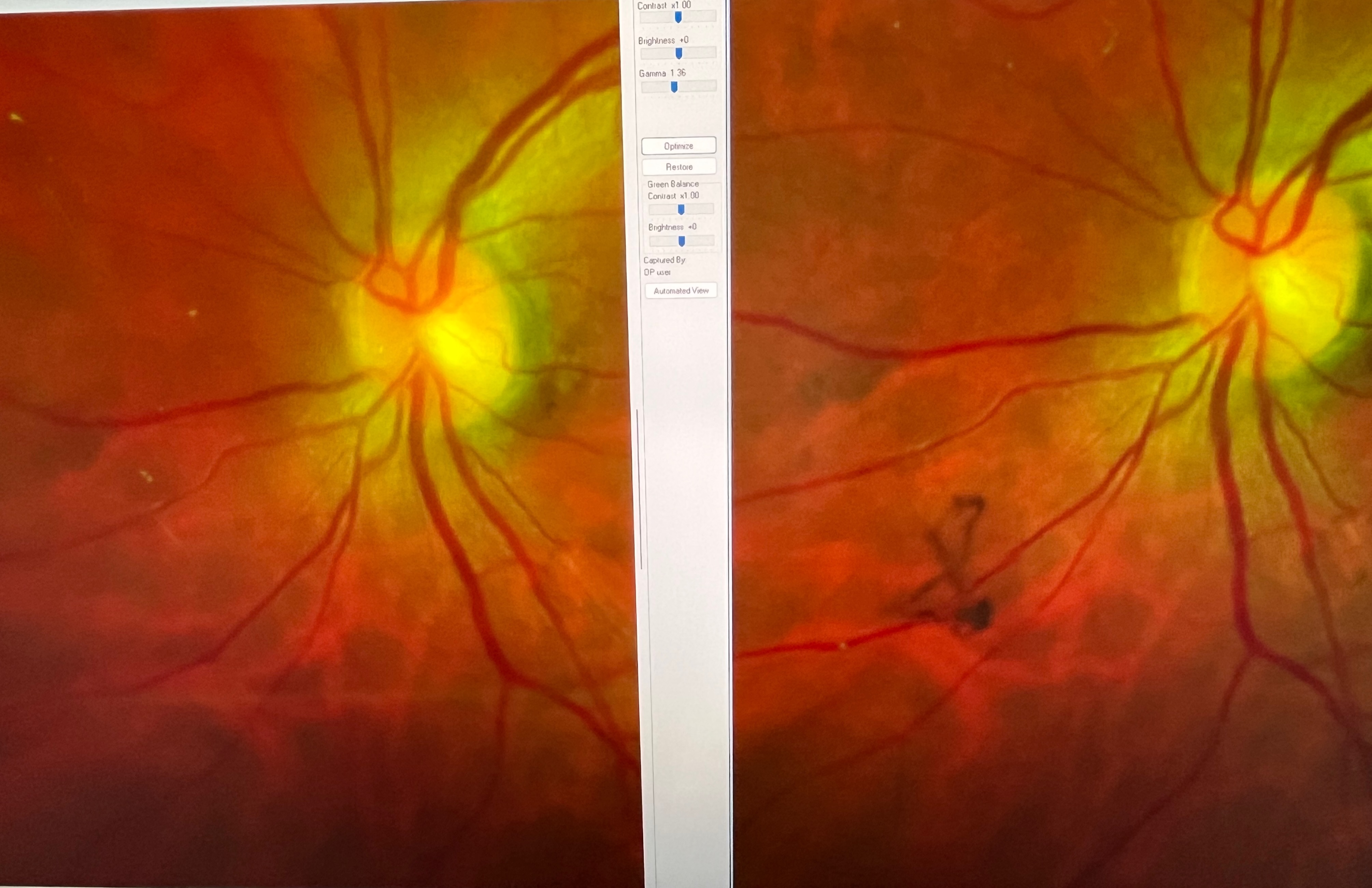 レーザー飛蚊症治療 | 柳津あおやま眼科クリニック