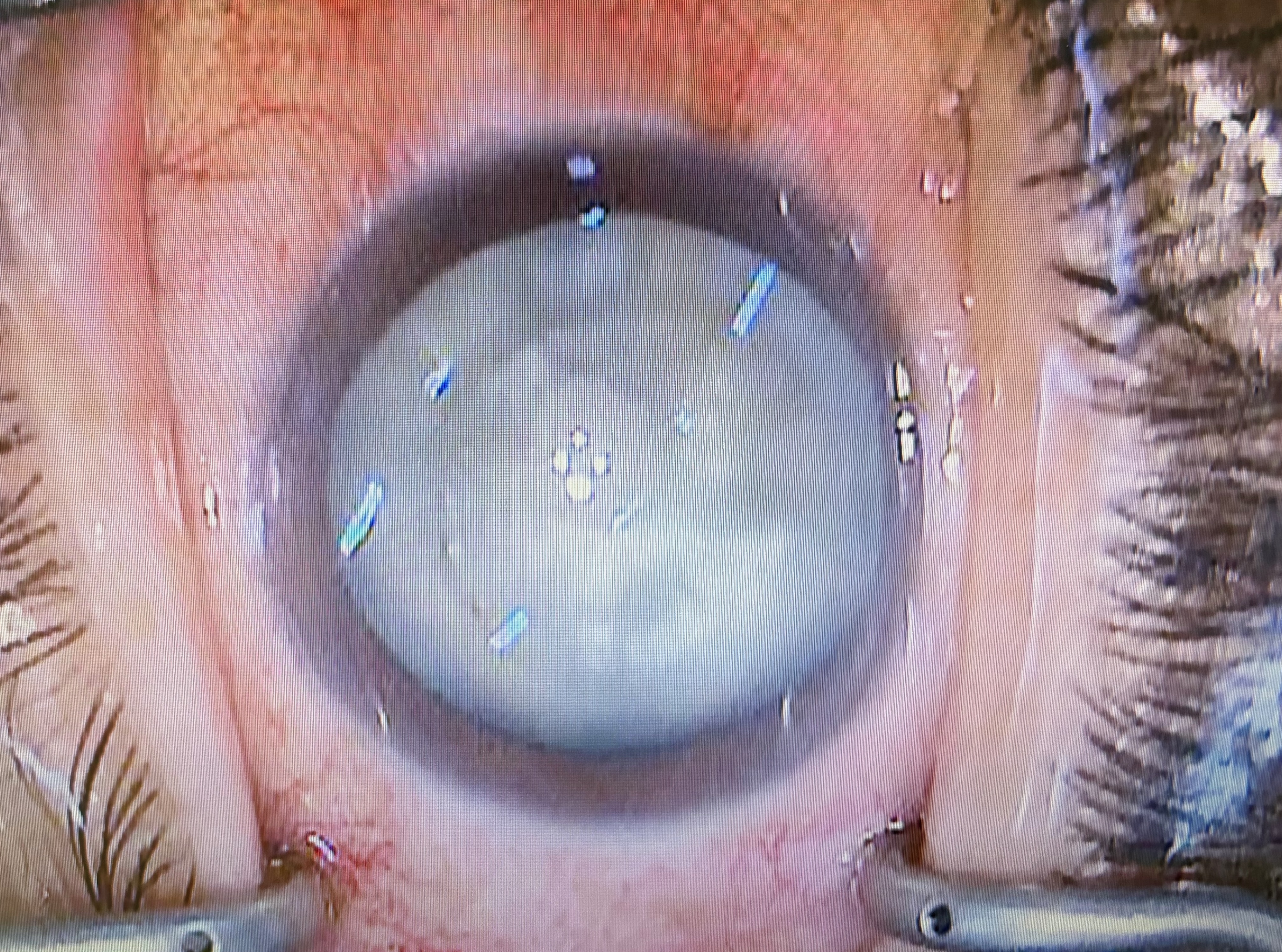 過熟白内障のレーザー手術 | 柳津あおやま眼科クリニック