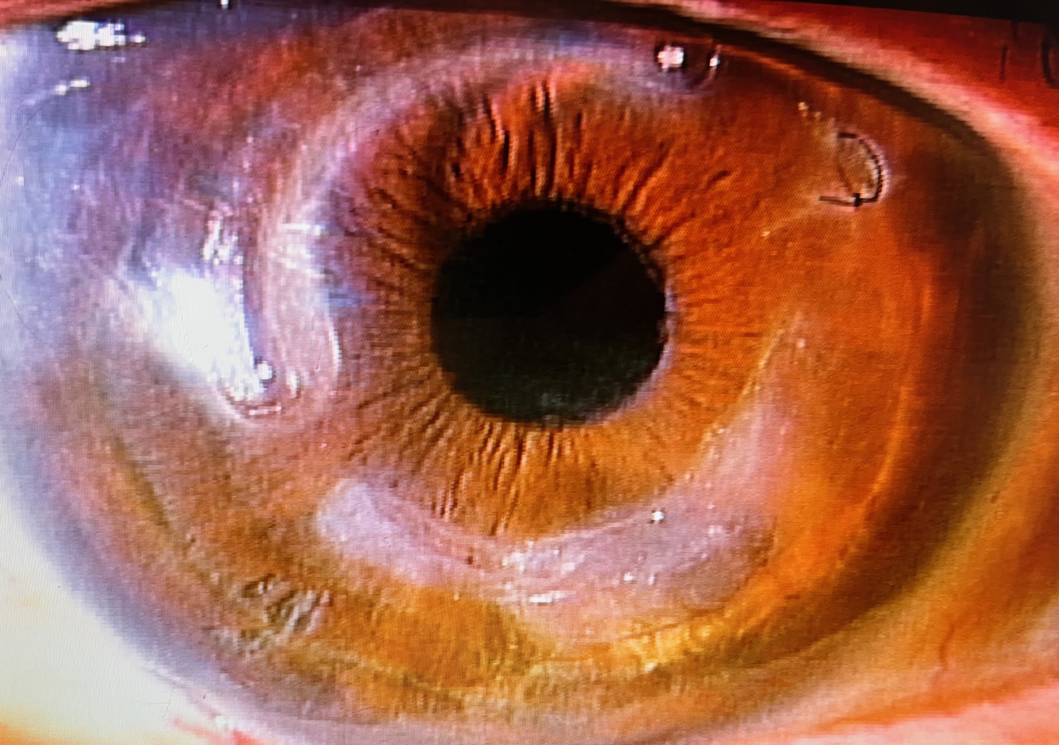 角膜移植後、など | 柳津あおやま眼科クリニック